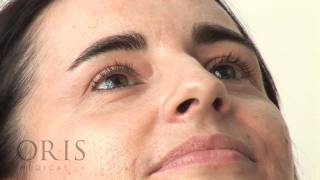 Botox training  Crows Feet  Oris Medical [upl. by Cornia]