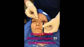 Droopy Upper Eyelids Ptosis Surgery [upl. by Sparks]