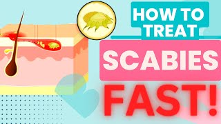 HOW TO TREAT SCABIES FAST TREATMENT AND HOME REMEDIES [upl. by Nagap997]