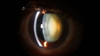 Slit Lamp examination of the anterior segment of the eye [upl. by Enirolf]