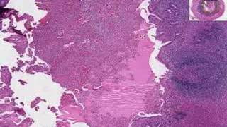 Histopathology Acute Appendicitis [upl. by Narruc601]