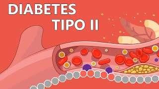 Diabetes tipo 2  Explicada Fácilmente Para Pacientes [upl. by Chilcote169]