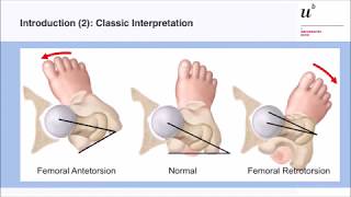 M Tannast In amp outtoeing a reliable diagnostic sign for femoral malversion Hip Symposium 2018 [upl. by Llaccm104]