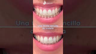 Tratamiento para la sonrisa gingival con botox [upl. by Yrtnahc]