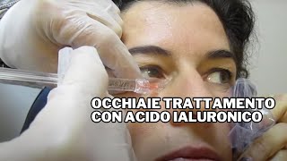 Occhiaie Trattamento con Acido Ialuronico [upl. by Paluas836]