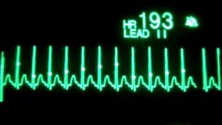 Supraventricular Tachycardia with Synchronized Cardioversion [upl. by Ainotna]