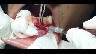 Epulis of gum  Gum epulis excision  Dr Hitesh Patel [upl. by Simon842]