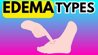 DIFFERENT TYPES OF EDEMA  TRANSUDATE VS EXUDATE [upl. by Mirella177]