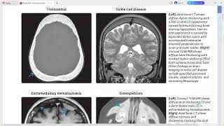 EXPERT DDX BRAIN AND SPINE IMAGING [upl. by Kahler]