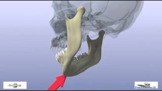 fractures of the mandibular condyle [upl. by Ahsot]