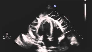 Echocardiogram of a Patient with Uremic Pericarditis [upl. by Allicsirp]