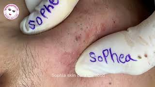 Acne facial removal treatment by Sopheaskincarecambodia 14th December 2023 [upl. by Miun]