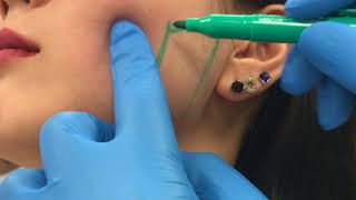 Treating enlarged masseter muscles with Botox by Dr Shaun Patel [upl. by Newel328]