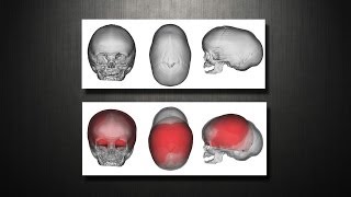 Craniosynostosis  Virtual Cranial Vault skull Reconstruction [upl. by Ybot44]