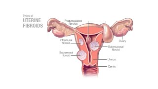 Mayo Clinic Minute  Can uterine fibroids affect pregnancy [upl. by Brockie]