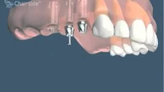 Implants dentaires et bridge sur implants pour remplacer plusieurs dents [upl. by Kary]