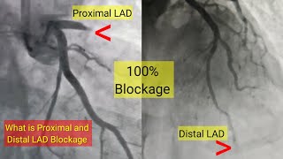 What is proximal and Distal LAD artery Blockage and Treatment l हार्ट ब्लॉकेज और ईलाज [upl. by Eesac]