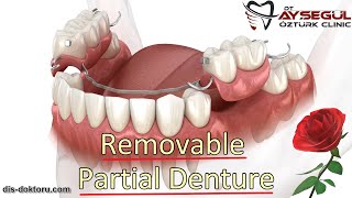 Removable Partial Denture [upl. by Julio600]