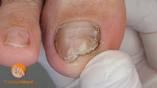 Nail psoriasis and onycholysis  Nail trimming and cleaning of the grooves Podología Integral [upl. by Aicnelev]