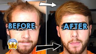 Going bald at 25  How I style my thinning receding hair [upl. by Naejarual698]