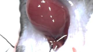 Hetrotopic Heart Transplant [upl. by Paine]