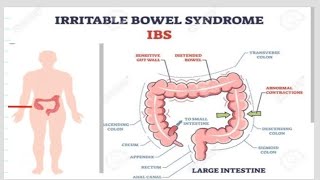 Irritable bowel syndromeIBS पाचन तंत्र से सम्बंधित बीमारीइरिटेबल बॉवल सिंड्रोम् [upl. by Iclek404]