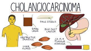 Understanding Cholangiocarcinoma [upl. by Ayomat]