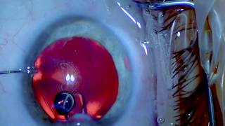 ICL Explantation  Senile Cataract  Nanolaser  Drmed AmirMobarez Parasta  MUNICH EYE [upl. by Ylecic]