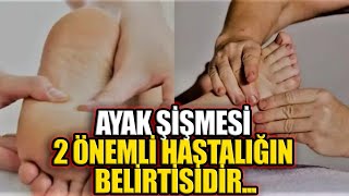 Ayak Şişmesi 2 Önemli Hastalığın Belirtisidir [upl. by Fina]