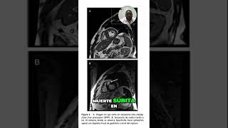 Identificación de Fibrosis Miocárdica en Resonancia Magnética [upl. by Llenwahs]