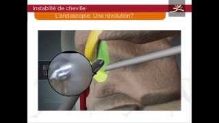 ligamentoplastie cheville arthroscopique type Brostrom Dr Guillo [upl. by Nnaeerb]