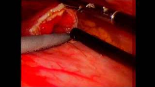 Laparoscopic gastric bezoar removal  UCSF Jonathan Carter MD [upl. by Niatsirk609]