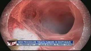 New procedure to treat tumors of the esophagus [upl. by Vish80]