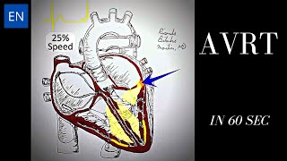 Atrioventricular Reentrant Tachycardia AVRT Animation and ECG Shorts [upl. by Lyon489]