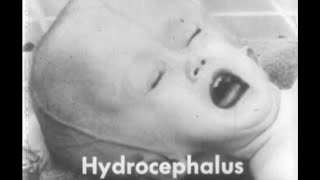 Hydrocephalus waterbrain 1950s Medical Teaching film on the quotFeeblemindedquot [upl. by Spohr]