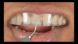 Direct composite veneers  Injection moulding technique  Complete Digital Workflow [upl. by Anaert]