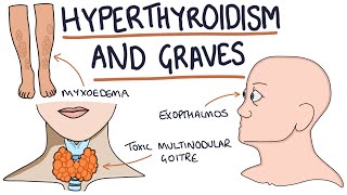 Understanding Hyperthyroidism and Graves Disease [upl. by Yaeger]