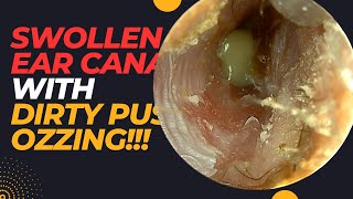 Narrow SWOLLEN Ear Canal With PUS Oozing [upl. by Ahtera]