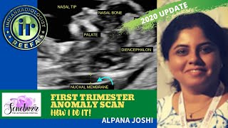 FIRST TRIMESTER ANOMALY SCAN  How I do it by Alpana Joshi  FETAL IMAGING  NASAL BONE amp NT [upl. by Louanne73]