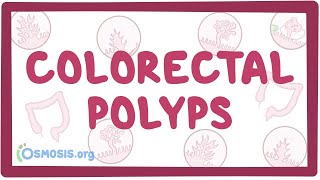 Colorectal polyps  an Osmosis Preview [upl. by Nuyh317]