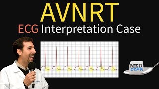 AV Nodal Reentry Tachycardia AVNRT on ECG  EKG [upl. by Munafo301]