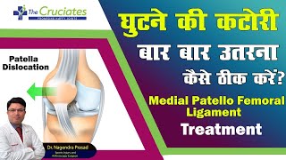 घुटने की कटोरी खिसकना  Knee cap or Patella Dislocation Treatment  MPFL Ligament Injury Treatment [upl. by Olodort]