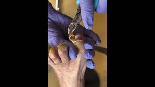 How to trim old toenails With Technically  Cleaning Nails long [upl. by Slorac]