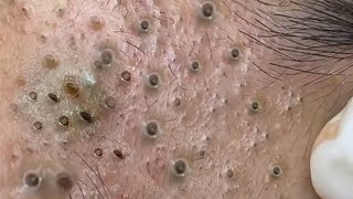 Big Cystic Acne Blackheads Extraction Blackheads amp Milia Whiteheads Removal Pimple Popping  8272 [upl. by Eilyw68]