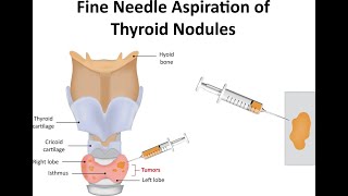 Understanding Thyroid Cancer Types Risks and Treatments copy [upl. by Thorbert]