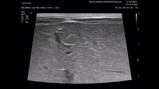 Necrotizing enterocolitis NEC Ultrasound [upl. by Janna]