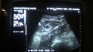 ruptured ECTOPIC PREGnancy at 2 wks gestational age [upl. by Anekam]