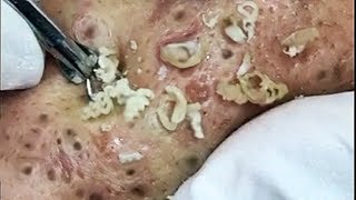 Big Blackheads Extraction from Cheeks  Best Pimple Popping videos [upl. by Ishmul]