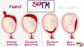 APH Antepartum haemorrhage [upl. by Aimahc]