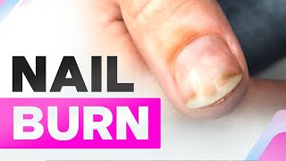 Nail Burn  Onycholysis  Clean Manicure [upl. by Tocci841]